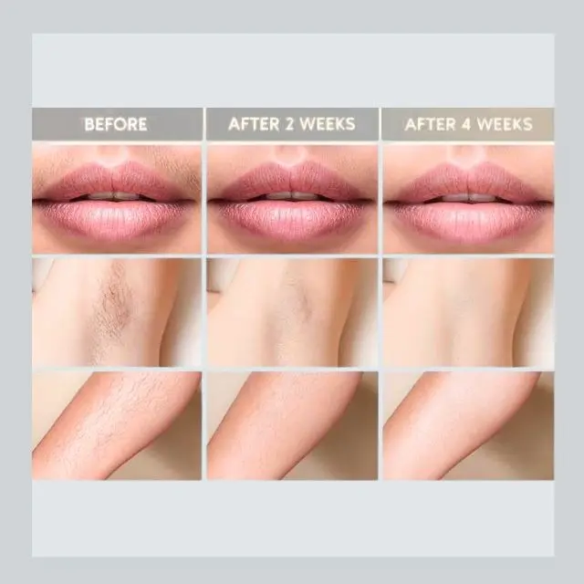 hair-removal-3-AQEZVgGJOEIMp5aJ.webp